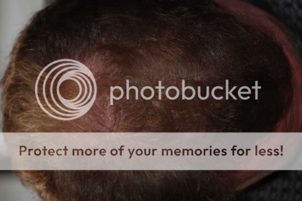 hair photo:laser hair loss 
