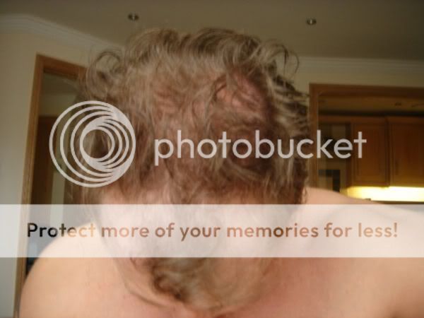 hair photo:vitamin deficiency hair loss 